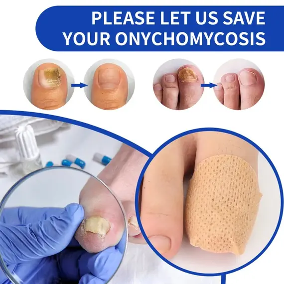Nail Repair Patches Toenail Fungus Patch Sticky Toenail Care Nail Ingrown Correction Sticker Paronychia Disposable Toe Patch
